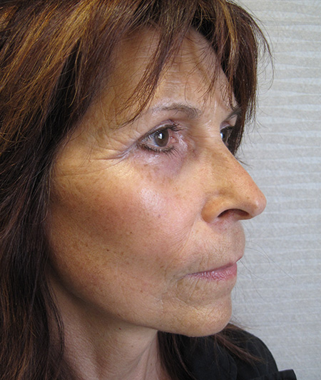 Après Lifting Cervico-facial - Patiente 1