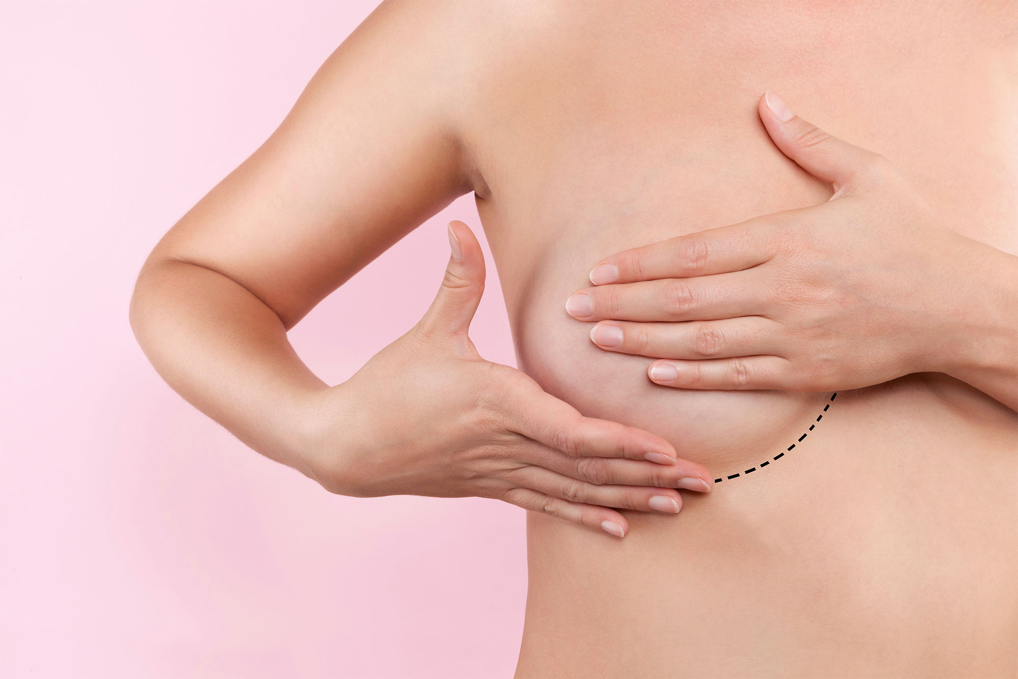 Augmentation mammaire par prothéses