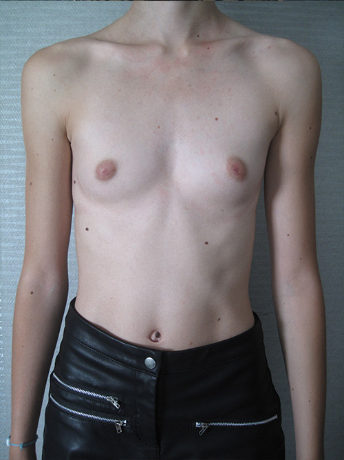 Prothese mammaire avant