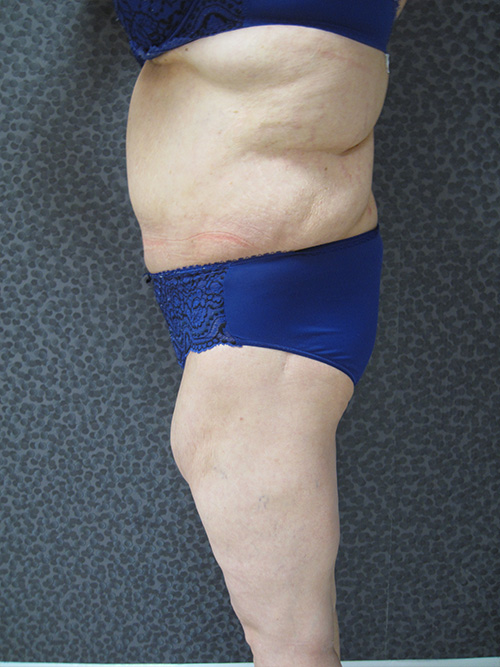 Patiente 1 - Abdominoplastie après