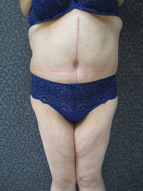 Patiente 1 - Abdominoplastie après