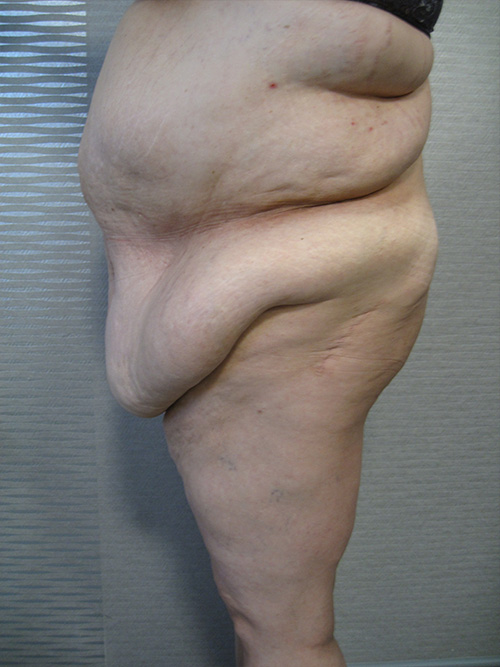 Patiente 1 - Abdominoplastie avant