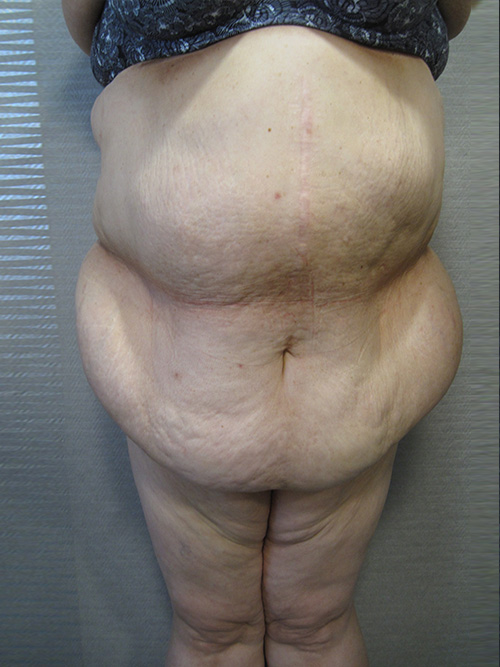 Patiente 1 - Abdominoplastie avant