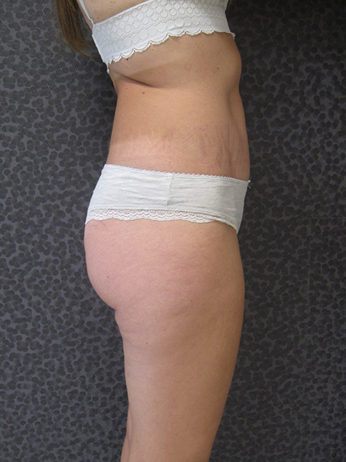 Patiente 5 - Abdominoplastie après