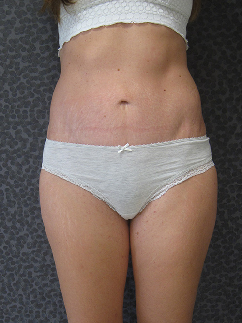 Patiente 5 - Abdominoplastie après