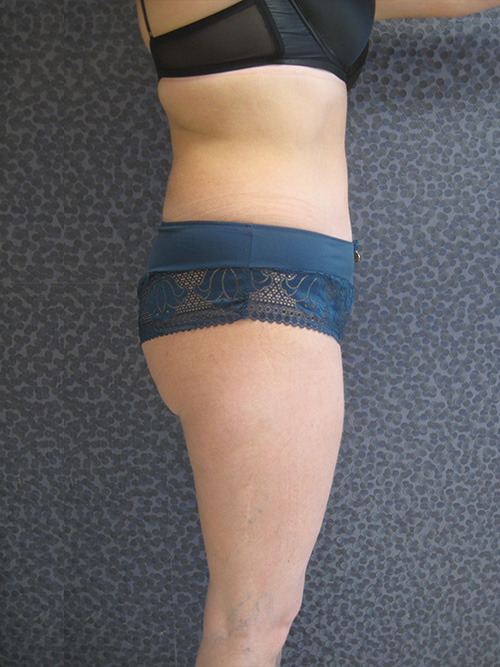 Patiente 6 - Abdominoplastie après