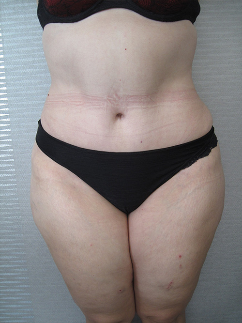 Patiente 2 - Abdominoplastie après