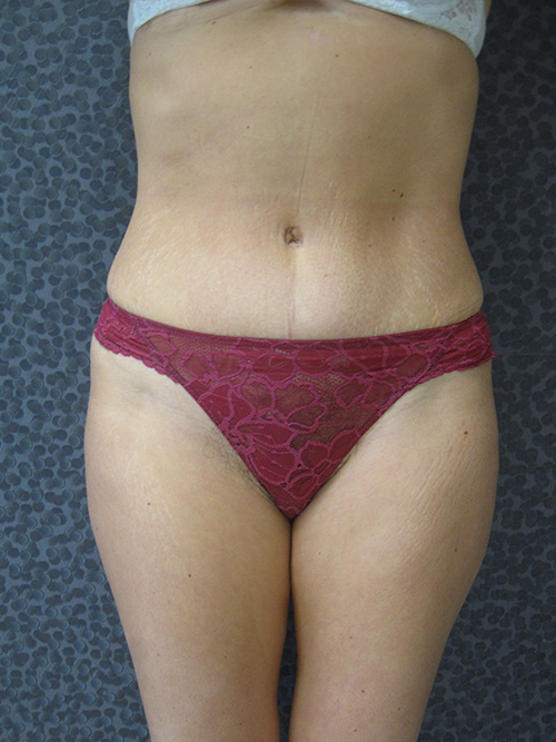 Patiente 7 - Abdominoplastie après