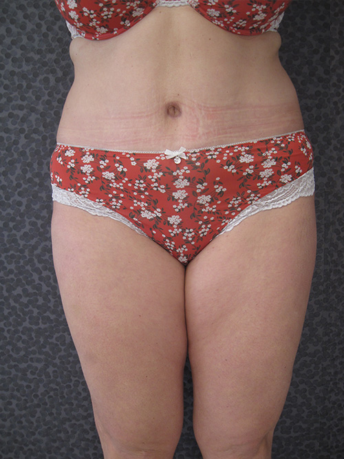 Patiente 3 - Abdominoplastie après