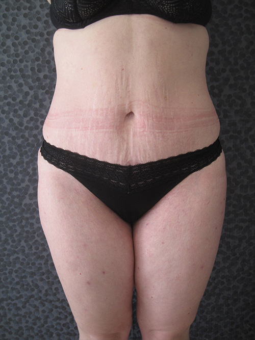 Patiente 4 - Abdominoplastie après