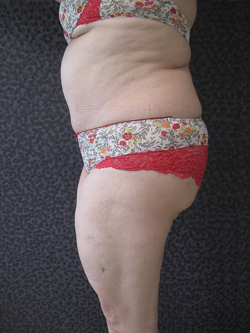 Patiente 8 - Abdominoplastie après