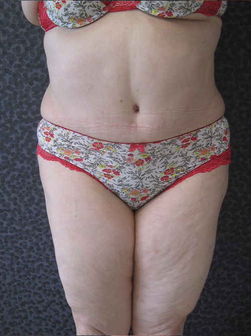 Patiente 8 - Abdominoplastie après