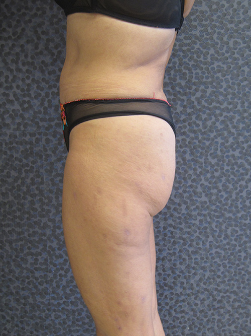 Patiente 9 - Abdominoplastie après