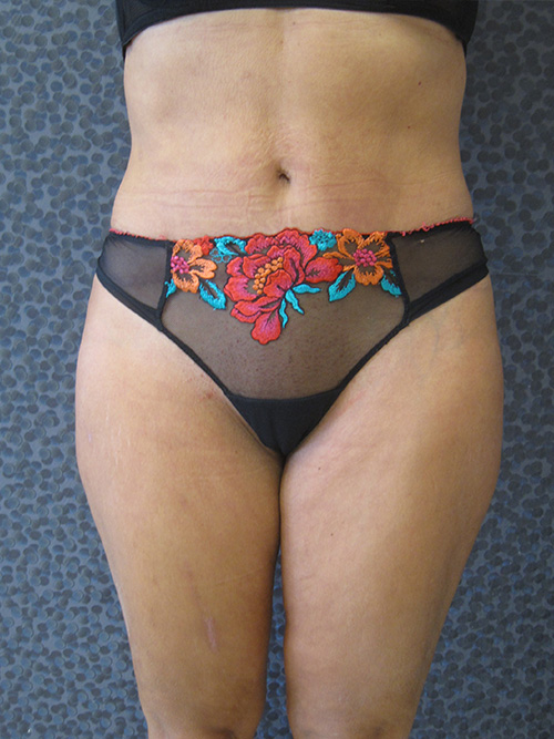 Patiente 9 - Abdominoplastie après