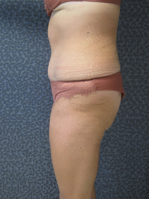 Patiente 10 - Abdominoplastie après
