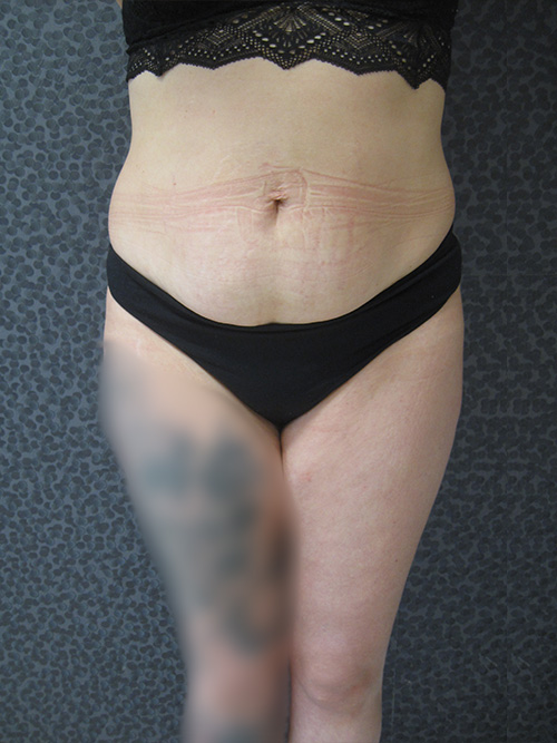 Patiente 6 - Abdominoplastie avant