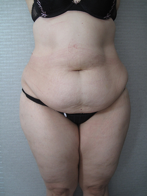 Patiente 2 - Abdominoplastie avant