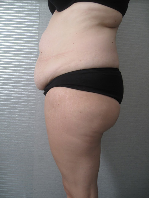 Patiente 11 - Abdominoplastie avant