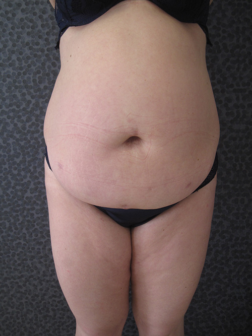 Patiente 1 - Abdominoplastie avant