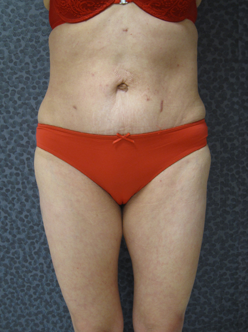 Patiente 20 - Abdominoplastie après