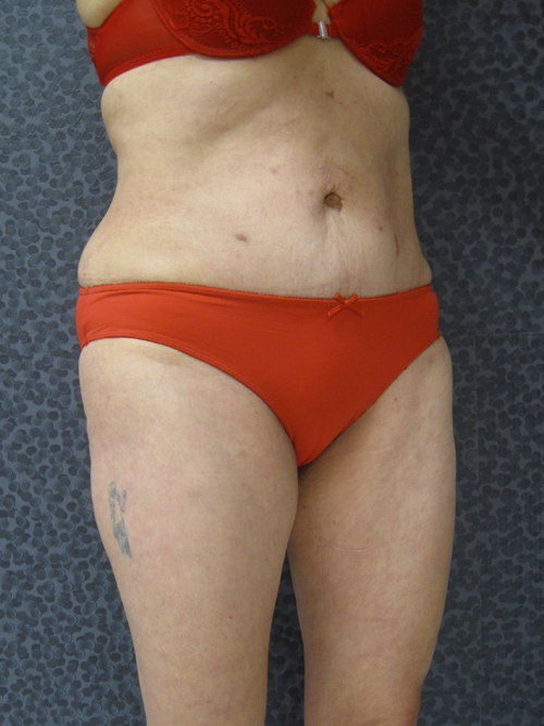 Patiente 20 - Abdominoplastie après