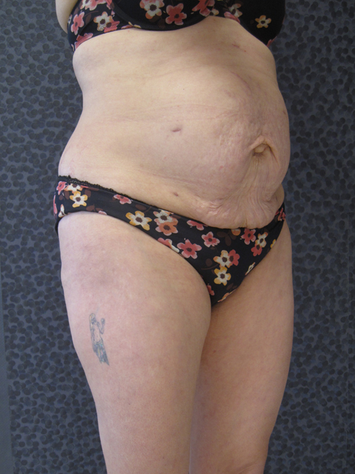 Patiente 20 - Abdominoplastie avant