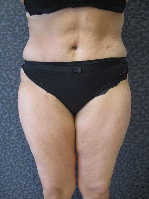 Patiente 14 - Abdominoplastie après