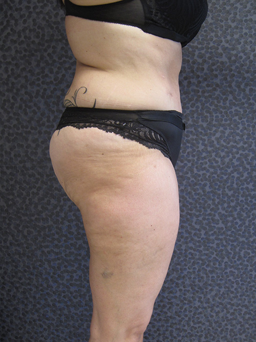 Patiente 14 - Abdominoplastie après