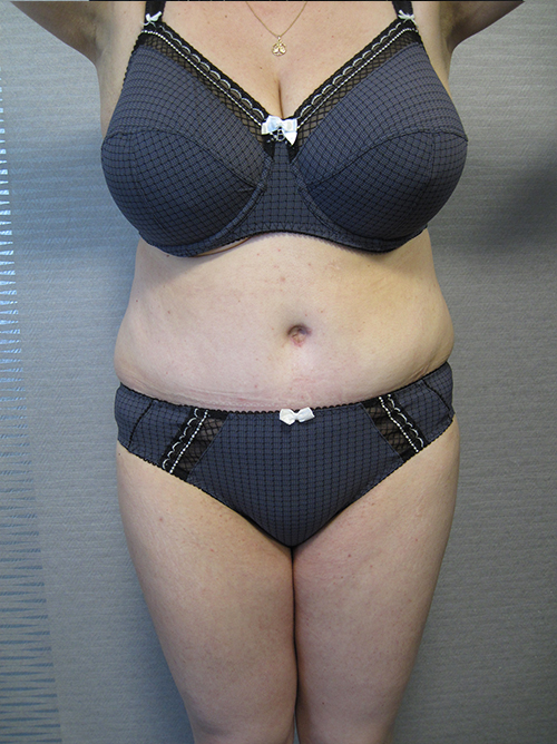 Patiente 18 - Abdominoplastie après