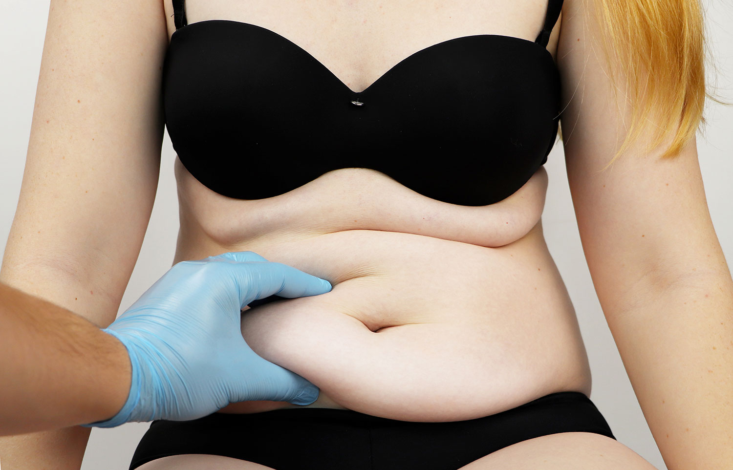 Abdominoplastie Geste opératoire