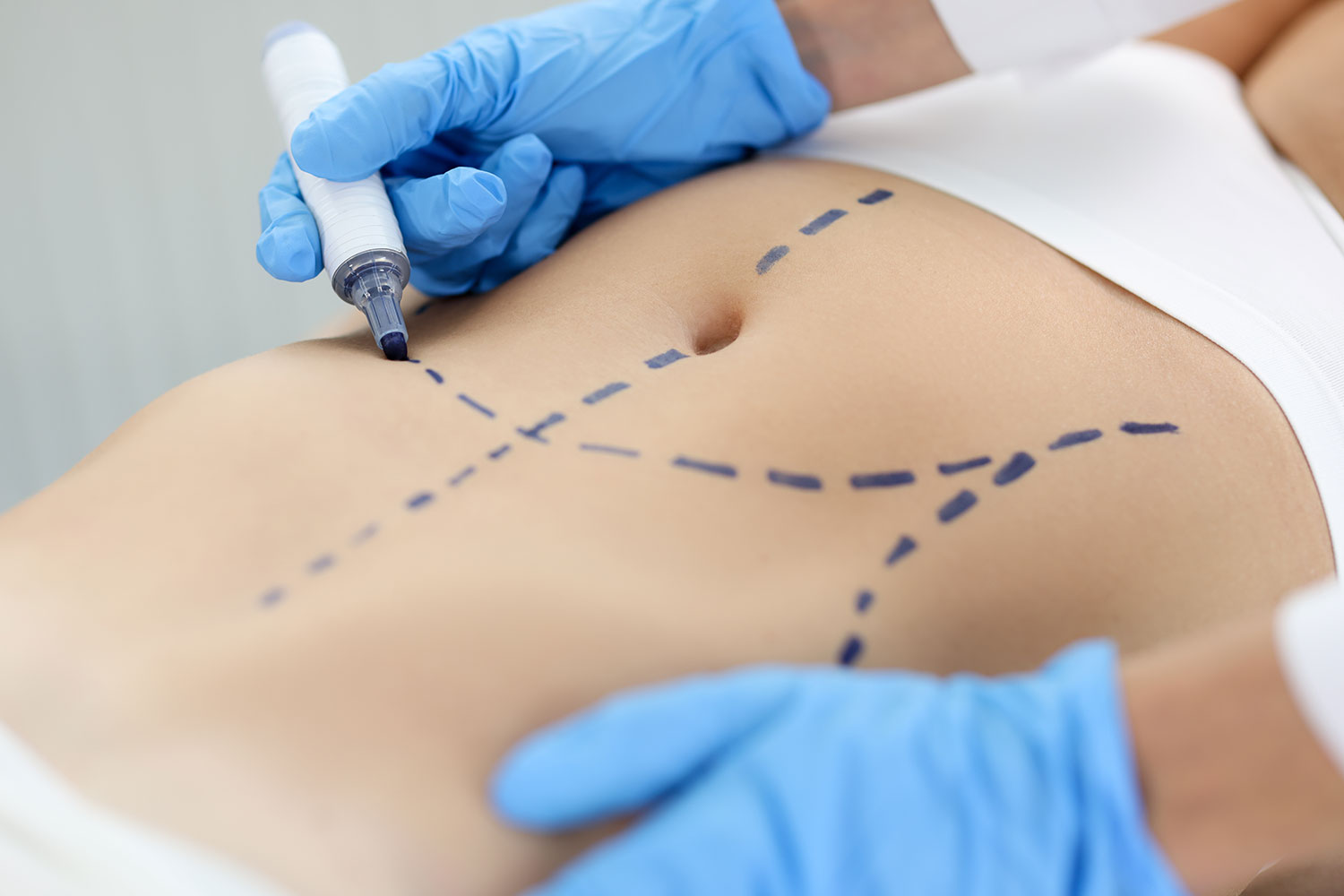 Abdominoplastie Chirurgie