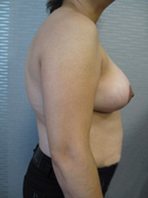Patiente 5 - reduction mammaire aapres