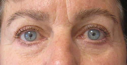 Patiente 2 - blepharoplastie après