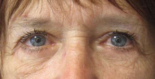 Patiente 5 - blepharoplastie après