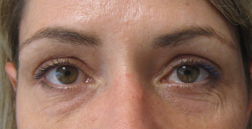 Patiente 2 - blepharoplastie après