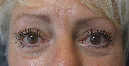 Patiente 1 - blepharoplastie après