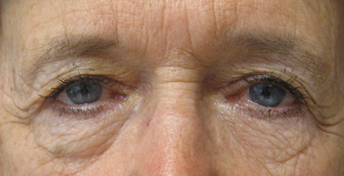 Patiente 5 - blepharoplastie avant