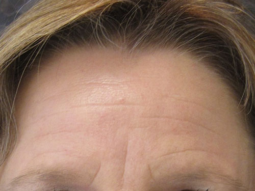 Patiente 1 - Botox avant