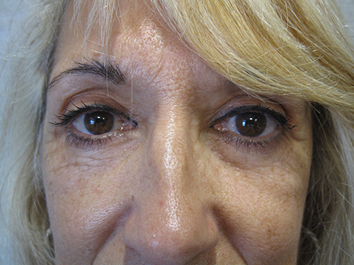 Patiente 4 - blepharoplastie après
