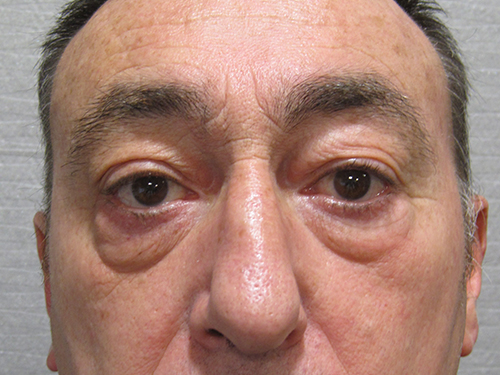 Patient 14 - blepharoplastie avant