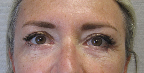 Patiente 4 - blepharoplastie après