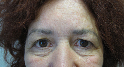 Patiente 4 - blepharoplastie avant