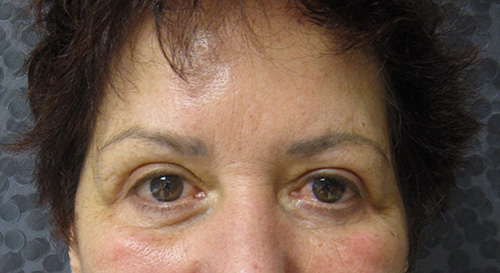 Patiente 4 - blepharoplastie après