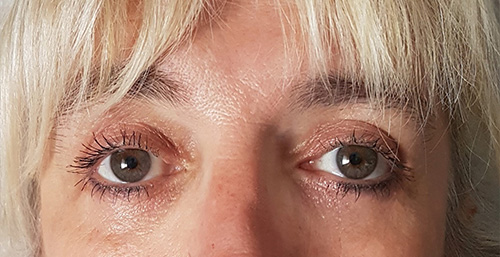 Patiente 4 - blepharoplastie après
