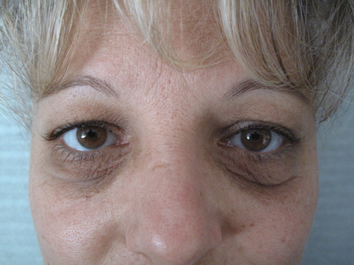 Patiente 4 - blepharoplastie avant
