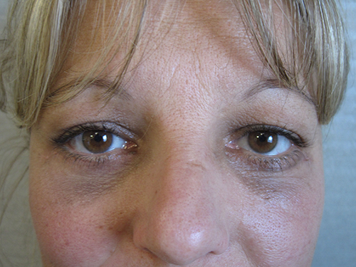 Patiente 4 - blepharoplastie après
