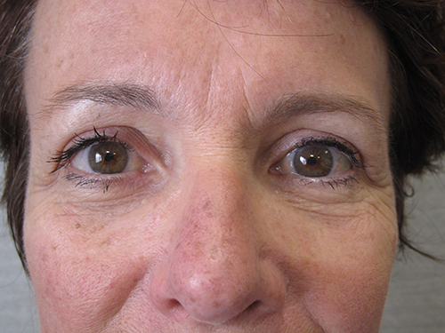 Patiente 4 - blepharoplastie après