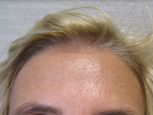 Patiente 3 - Botox après