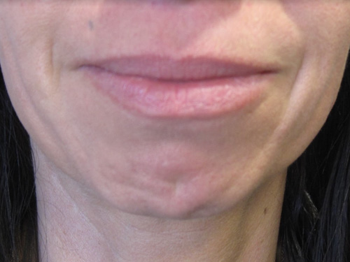 Patiente 4 - Botox avant