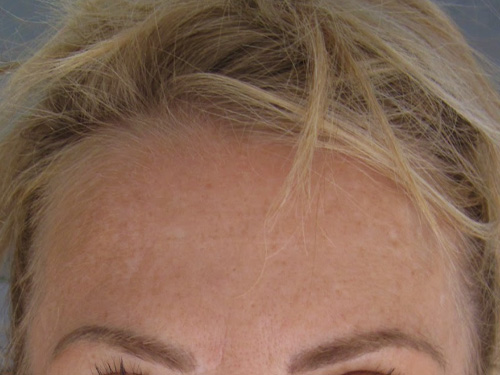 Patiente 2 - Botox avant